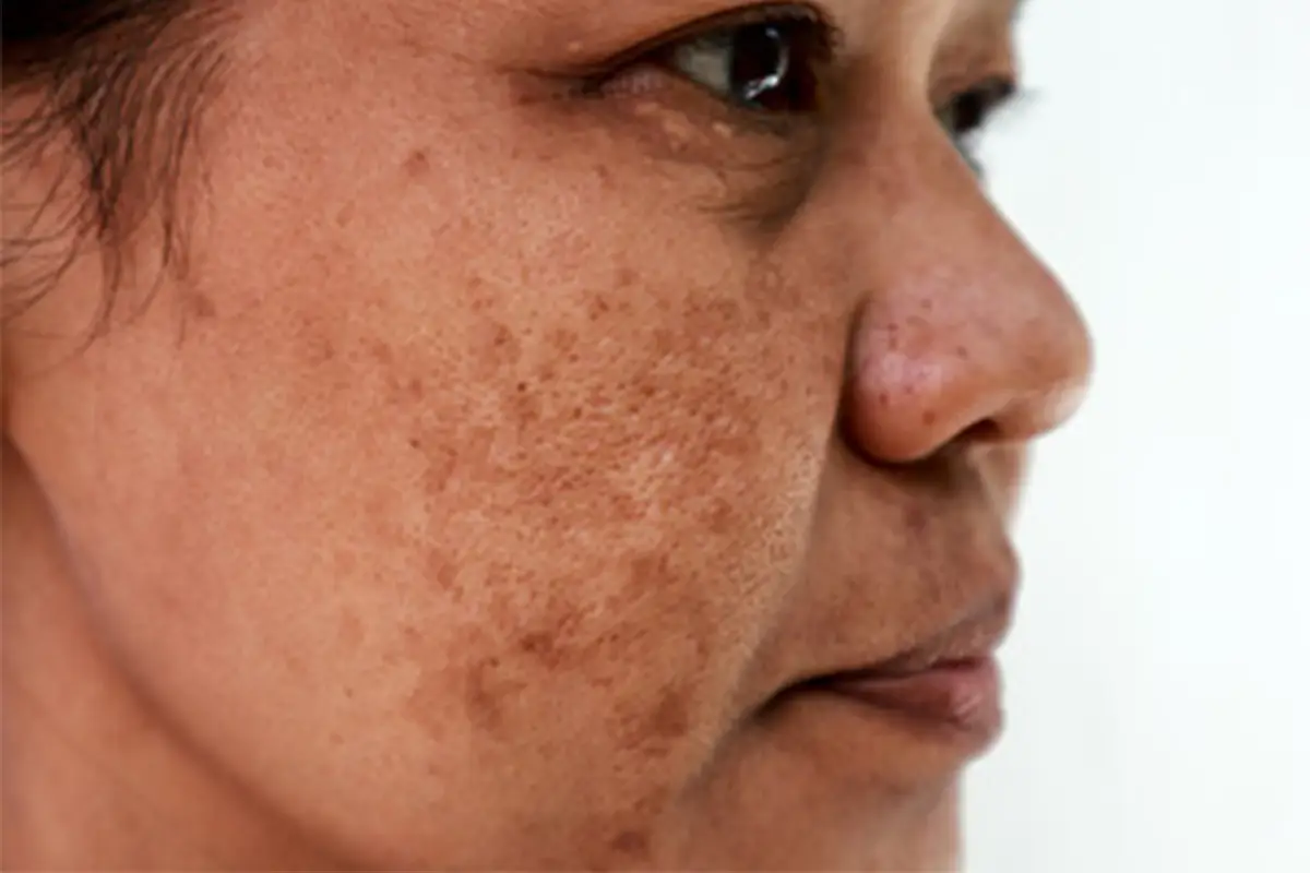 Melasma facial