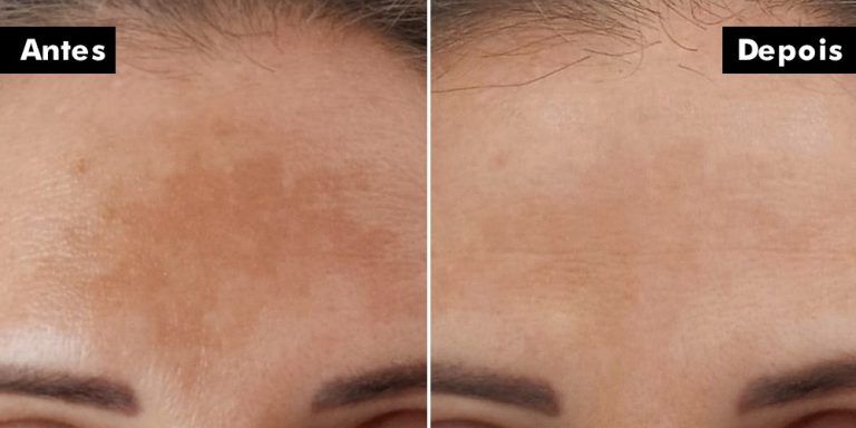 Melasma
